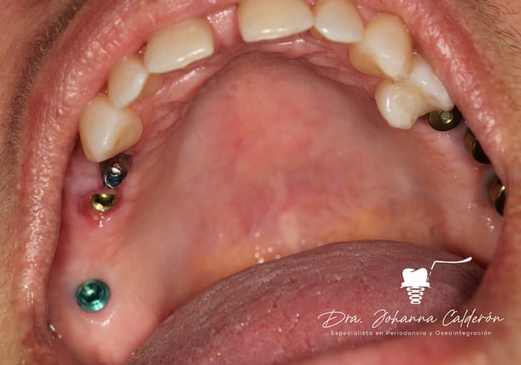Slider image (3) Dental Implants in Colombia Dr Johanna Calderon